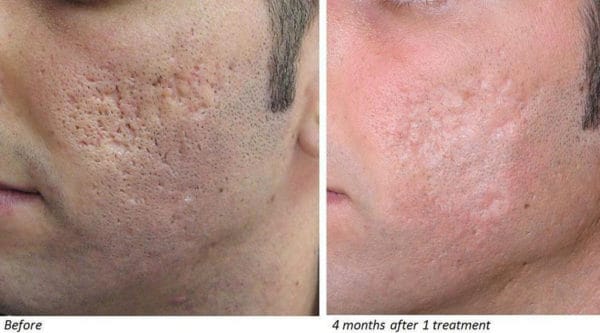 Acne scar treatment with CO2 Laser